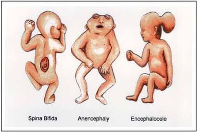 Birth defects