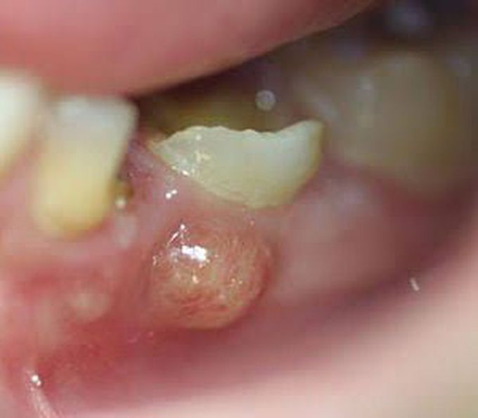 Symptoms of dental abscess