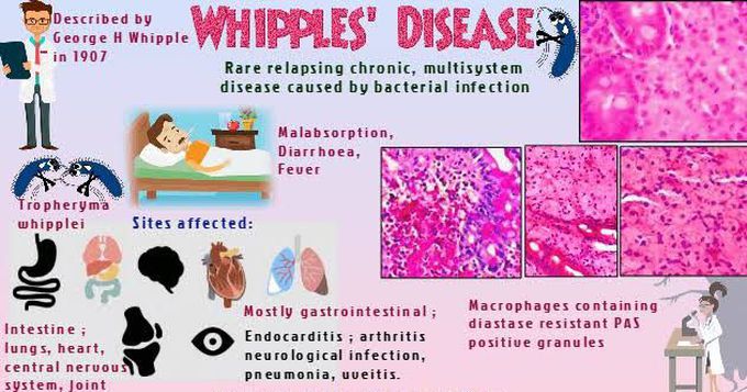 Whipples disease