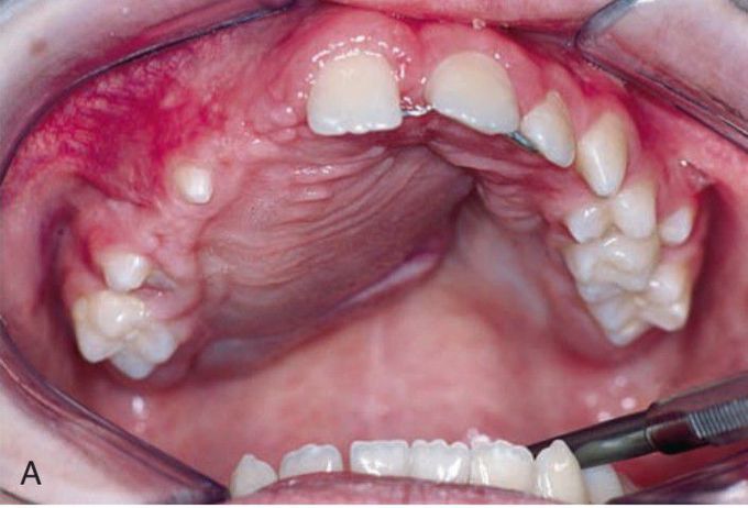 Central giant cell granuloma