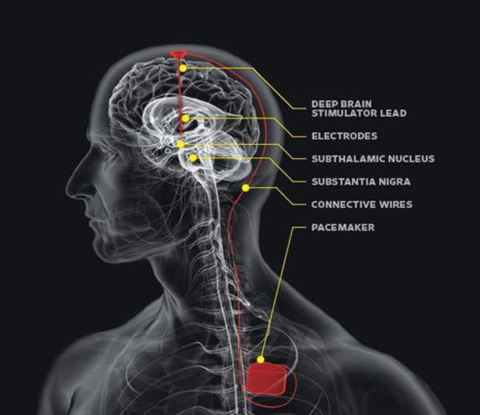 Deep brain stimulation