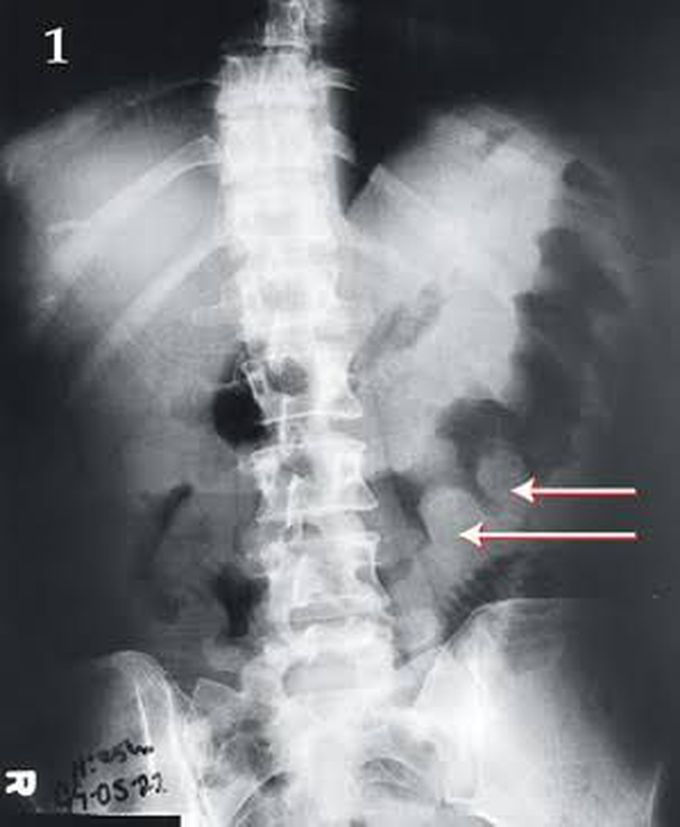 Thumbprint sign!! Seen in Pseudomembranous colitis