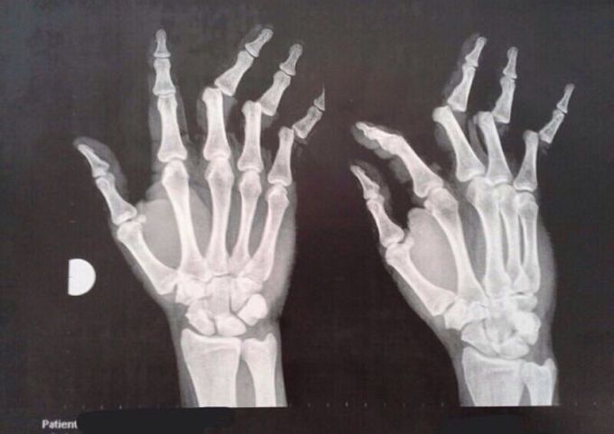Multiple finger dislocations caused by a fall