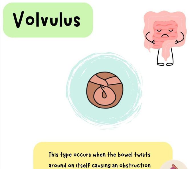 Volvulus