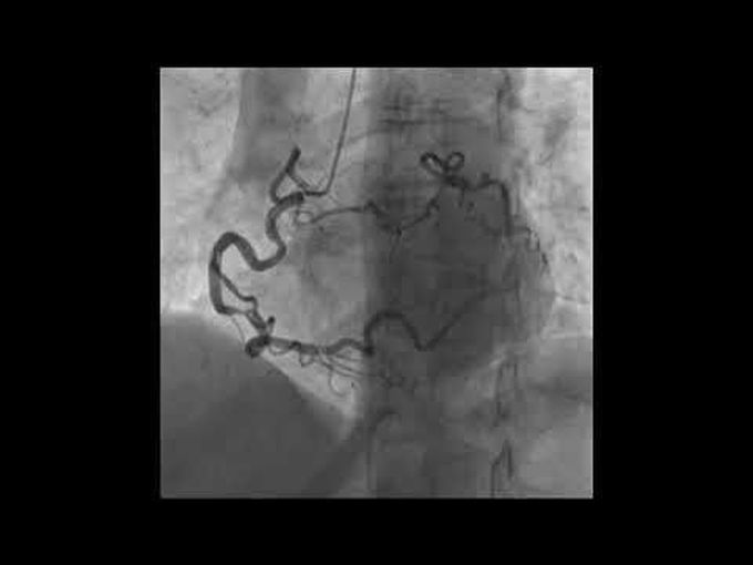 Isolated Coronary Artery