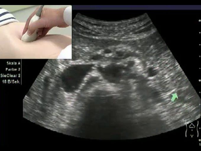 How to scan upper retroperitoneum by ultrasound (horizontal view )