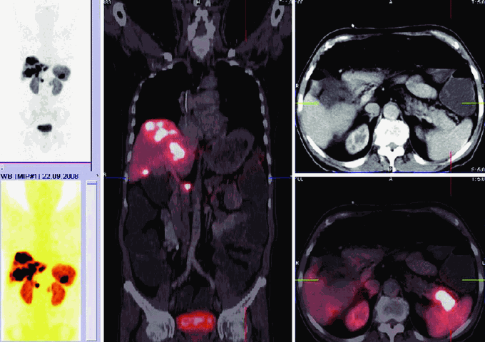 Pancreatic Cholera Syndrome AKA Verner-Morrison Syndrome