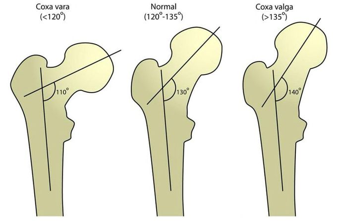 Hip Deformities