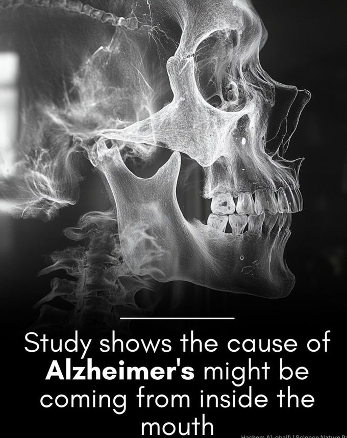 Alzheimer’s Disease Linked To Gum Disease