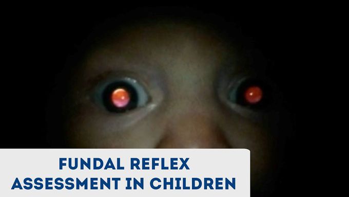 Fundal Reflex (a.k.a. Red Reflex) Assessment in Children - OSCE Guide