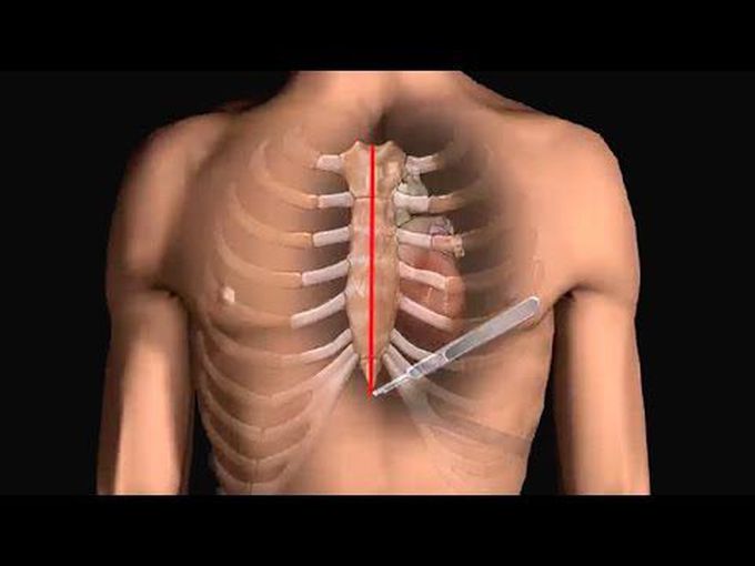 Bypass Surgery-Animation