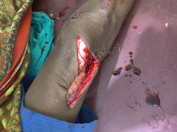 Deep laceration medizzy