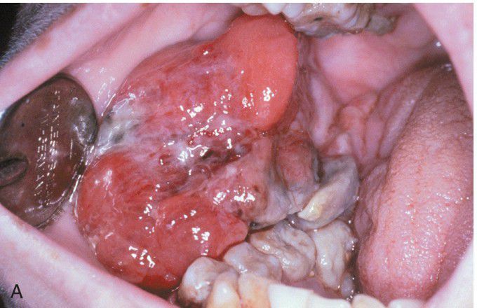 Ameloblastic Fibrosarcoma