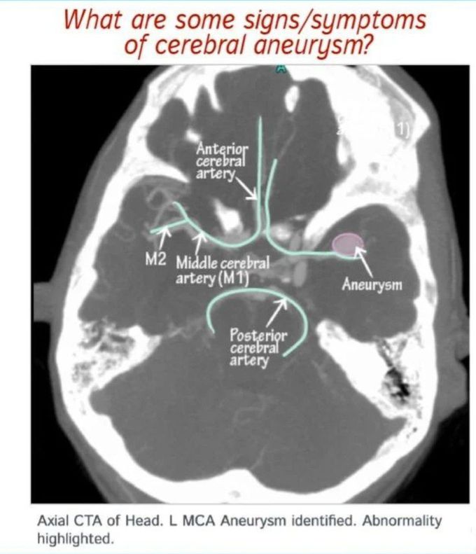 Cerebral Aneurysm