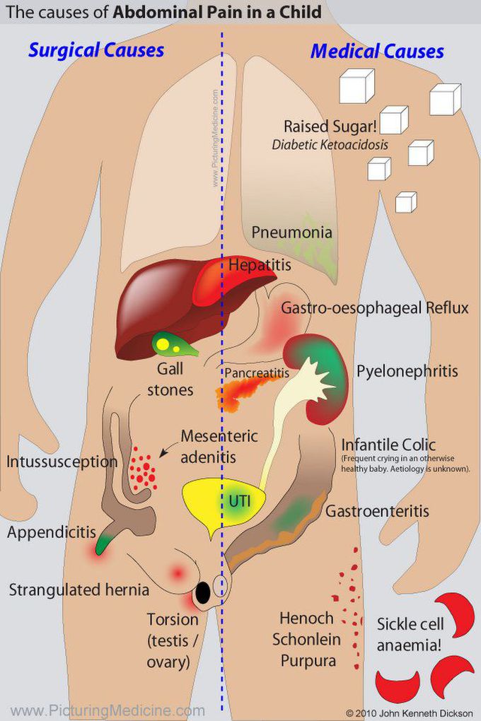 Abdominal pain in child