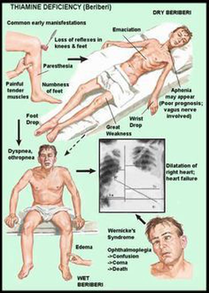 THIAMINE DEFICIENCY