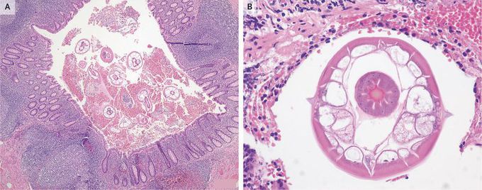 Appendiceal Pinworms