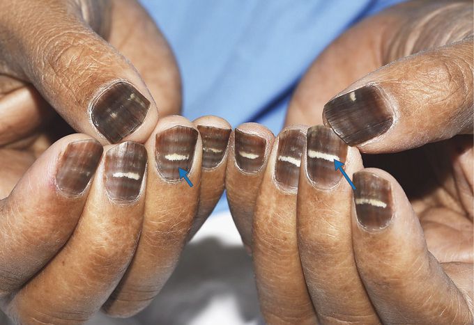Nail Changes during Chemotherapy