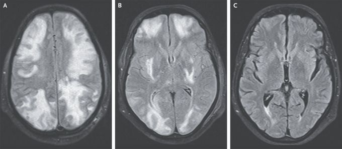 Posterior Reversible Encephalopathy Syndrome