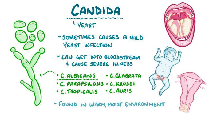 Candidiasis