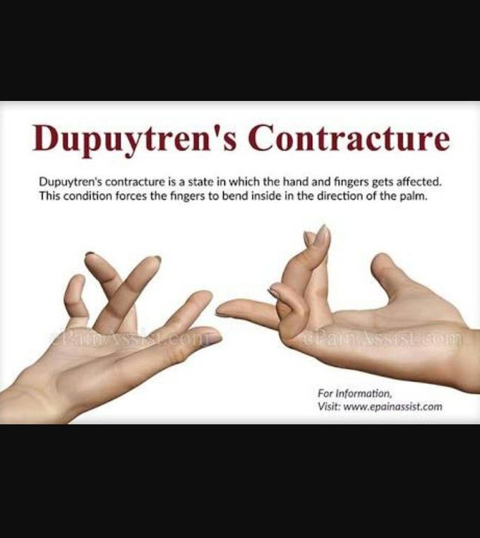 Dupuytren's contracture