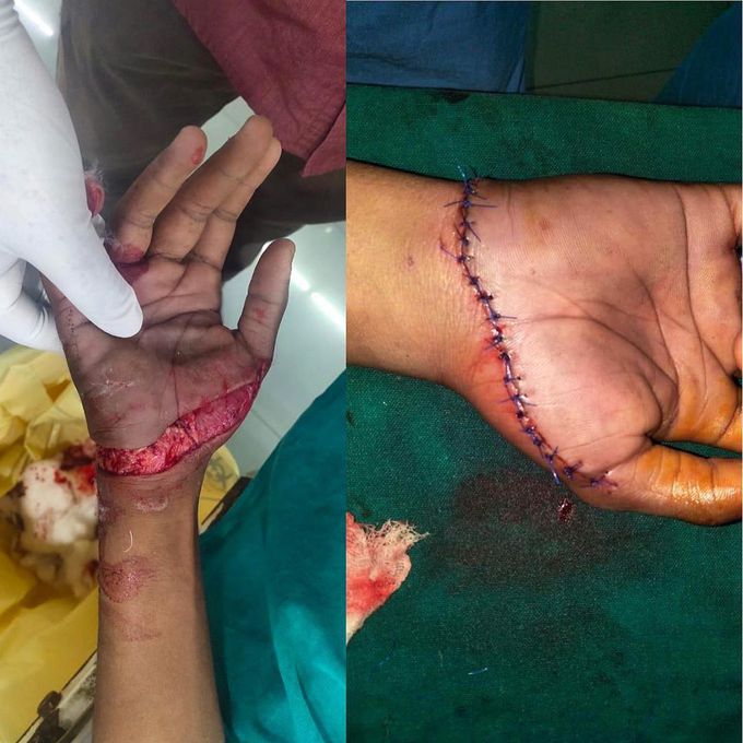 Deep hand laceration wound getting a precise suturing job! 