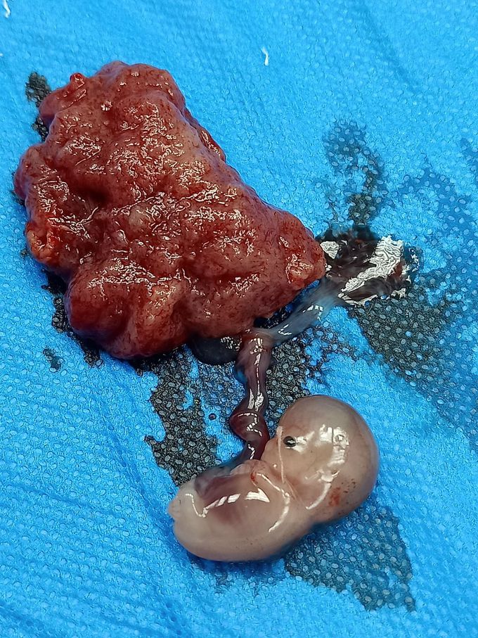 Tubal ectopic pregnancy