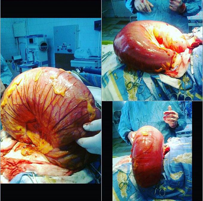 Inflated transverse colon! 🌀