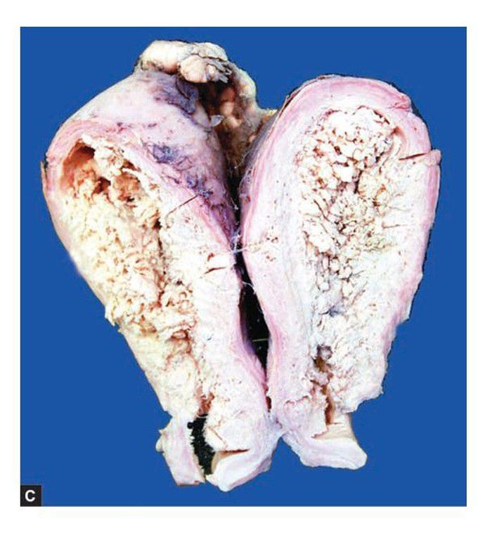 Endometrial carcinoma