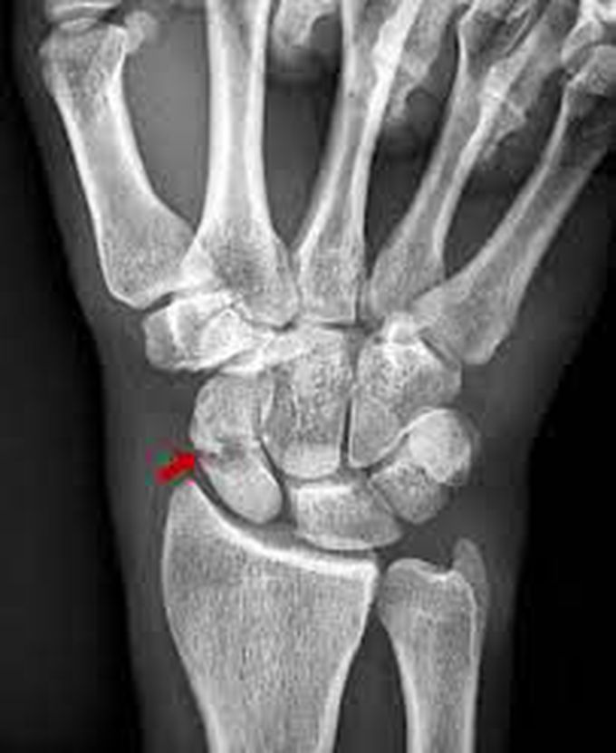 What causes scaphoid fractures