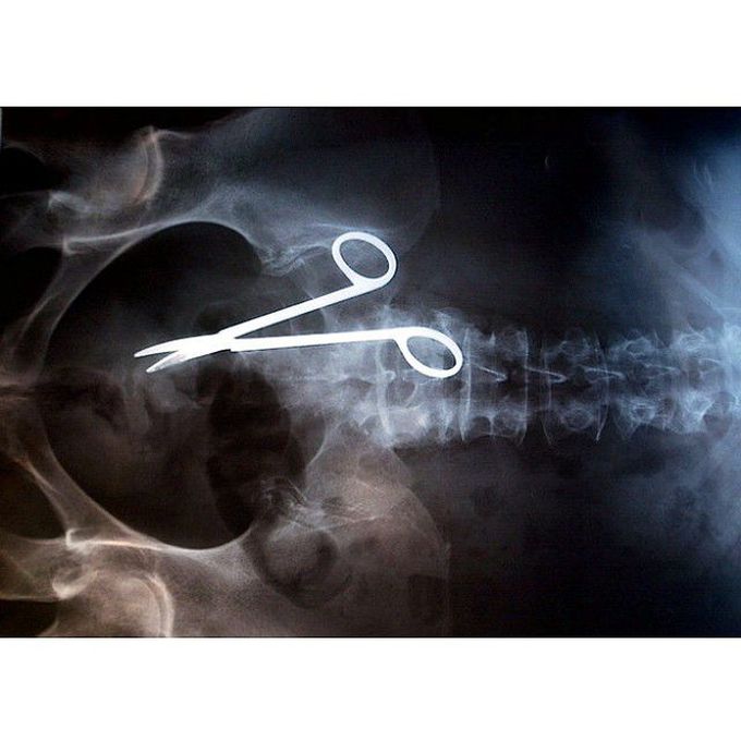 Surgical scissors left in the abdomen