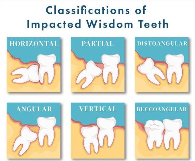 Classification of impacted wisdom teeth