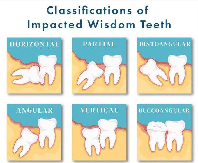 Classification of impacted wisdom teeth