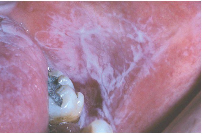 Graft-Versus-Host Disease (GVHD).