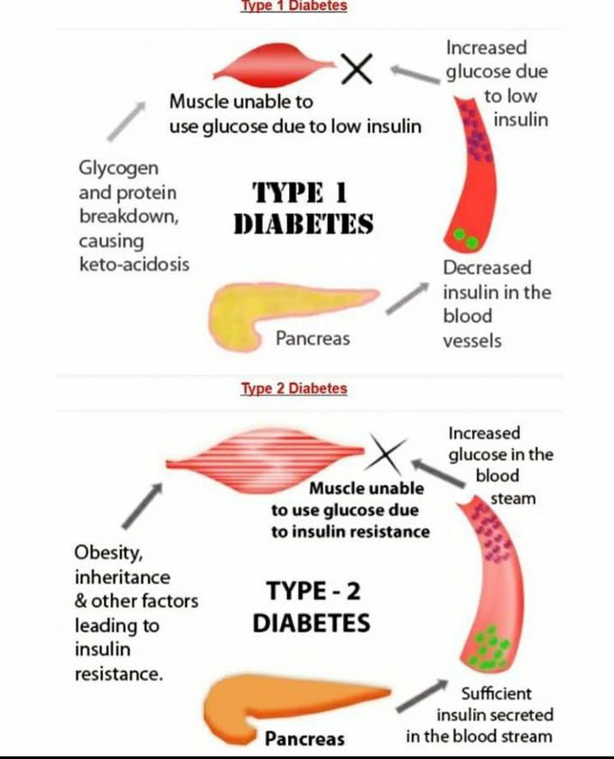 Type 1 and Type 2 diabetes