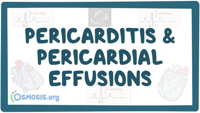 Pericarditis and pericardial effusions - causes, symptoms, diagnosis, treatment, pathology