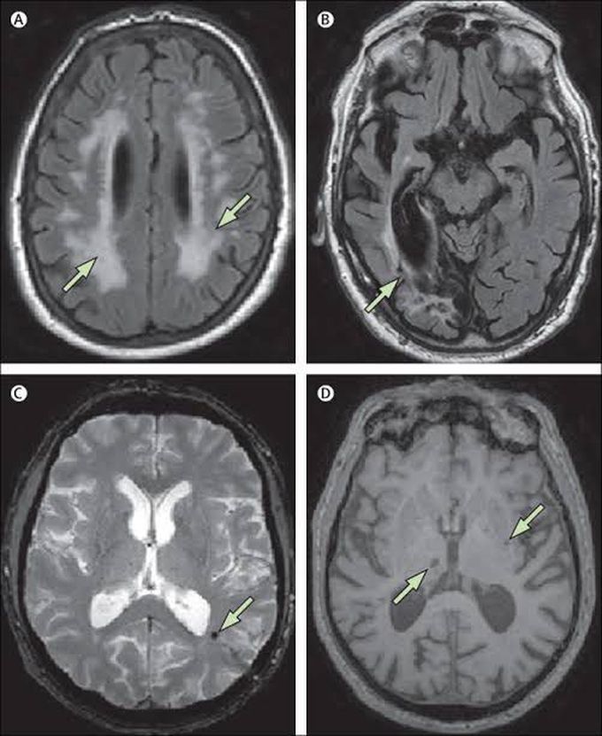 Vascular dementia