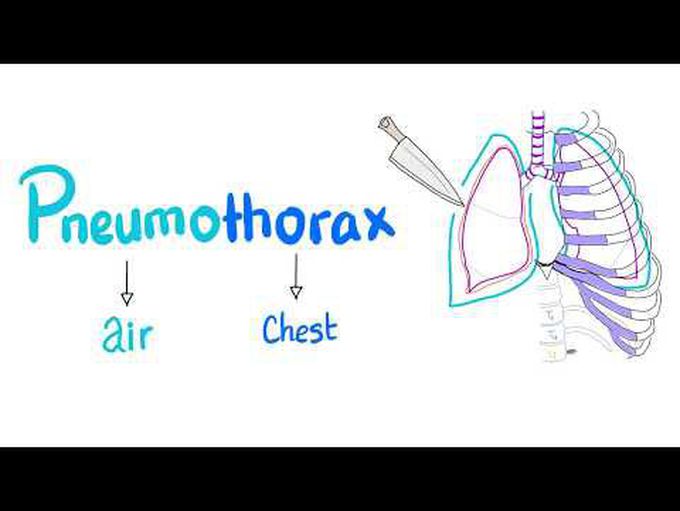 Pneumothorax | Lung Physiology | Pulmonary Medicine