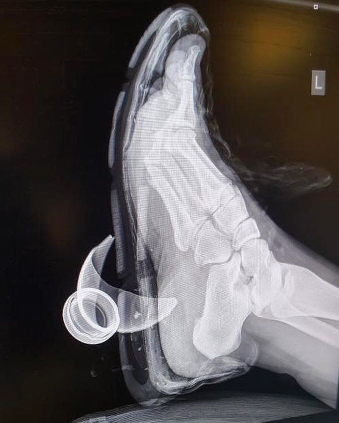 Foot injury with a glass of a Snapple bottle through the shoe and heel!  