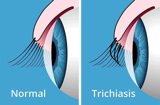 Trichiasis