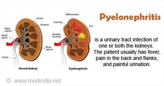 Pyelonephritis