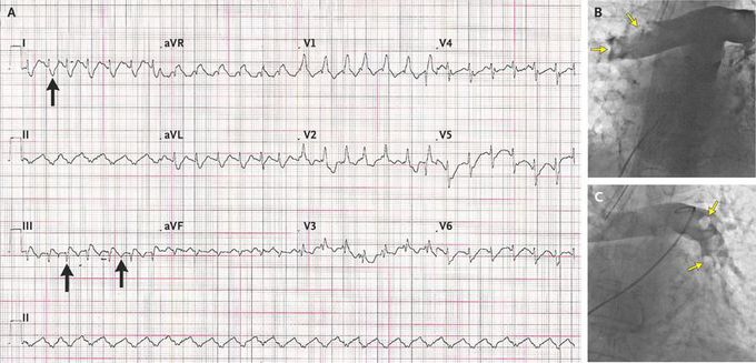 Percutaneous Rotational Pulmonary Thrombectomy