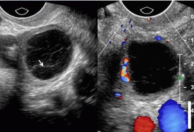 Adnexal mass