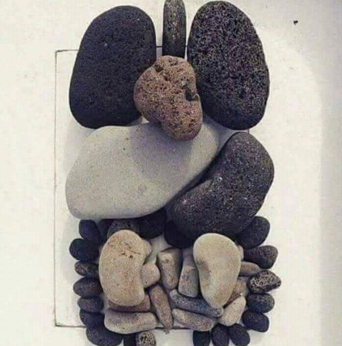 Human GIT despite by stones