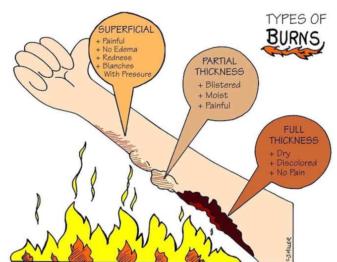 Burn