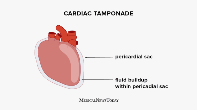 Cardiac tamponade