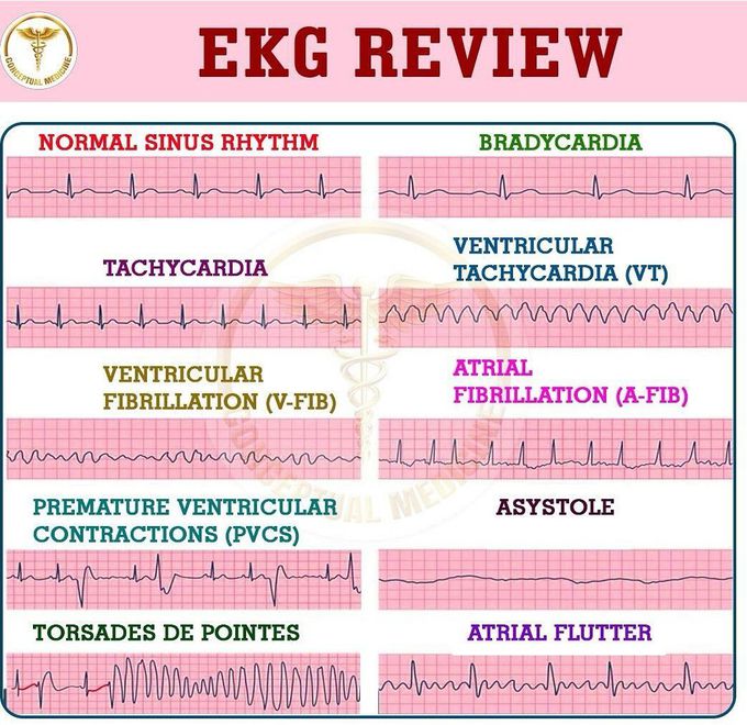 EKG Review