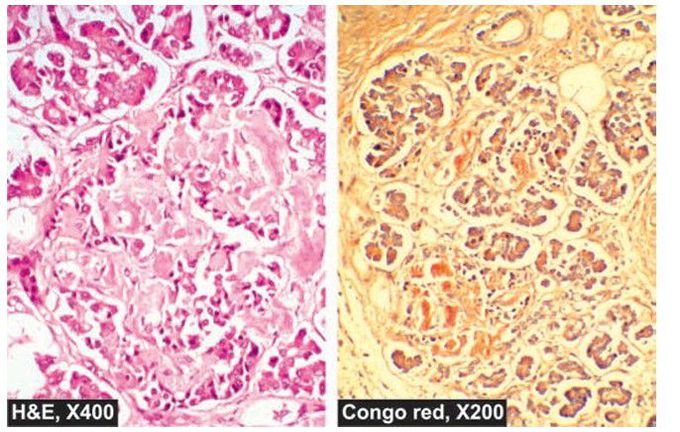 Amyloidosis of the pancreatic islet tissue.