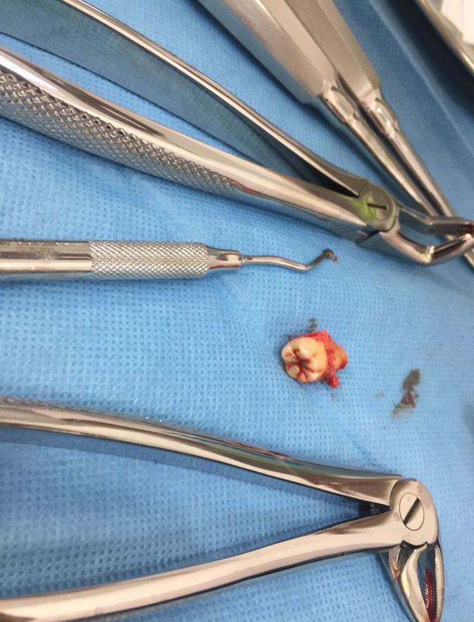 Third molar extraction 💉🔧