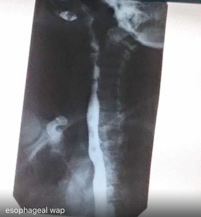 esophageal web barium swallow